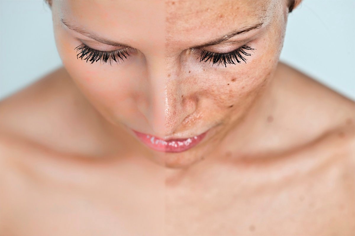 pigmentation